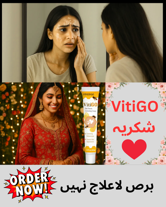 VITIGO CREAM - helping reduce the contrast between depigmented patches and surrounding skin